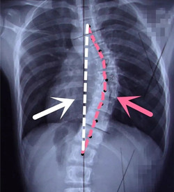 脊柱側(cè)彎后身高會變短嗎？