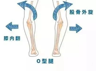 孩子“O”型腿怎么辦？