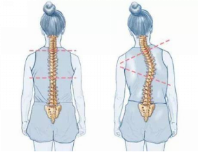 怕耽誤學(xué)習(xí)，脊柱側(cè)彎就不治療了嗎？