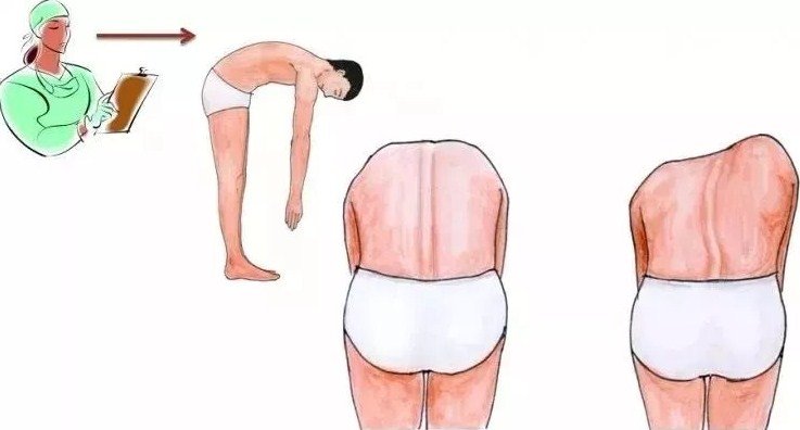脊柱側彎早發(fā)現(xiàn)，早治療