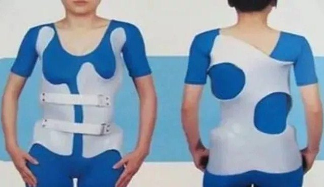 脊柱側彎早發(fā)現(xiàn)，早治療